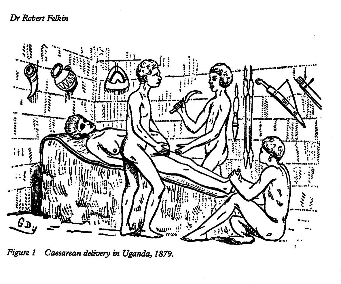 Caesarean delivery Buganda 1879-2