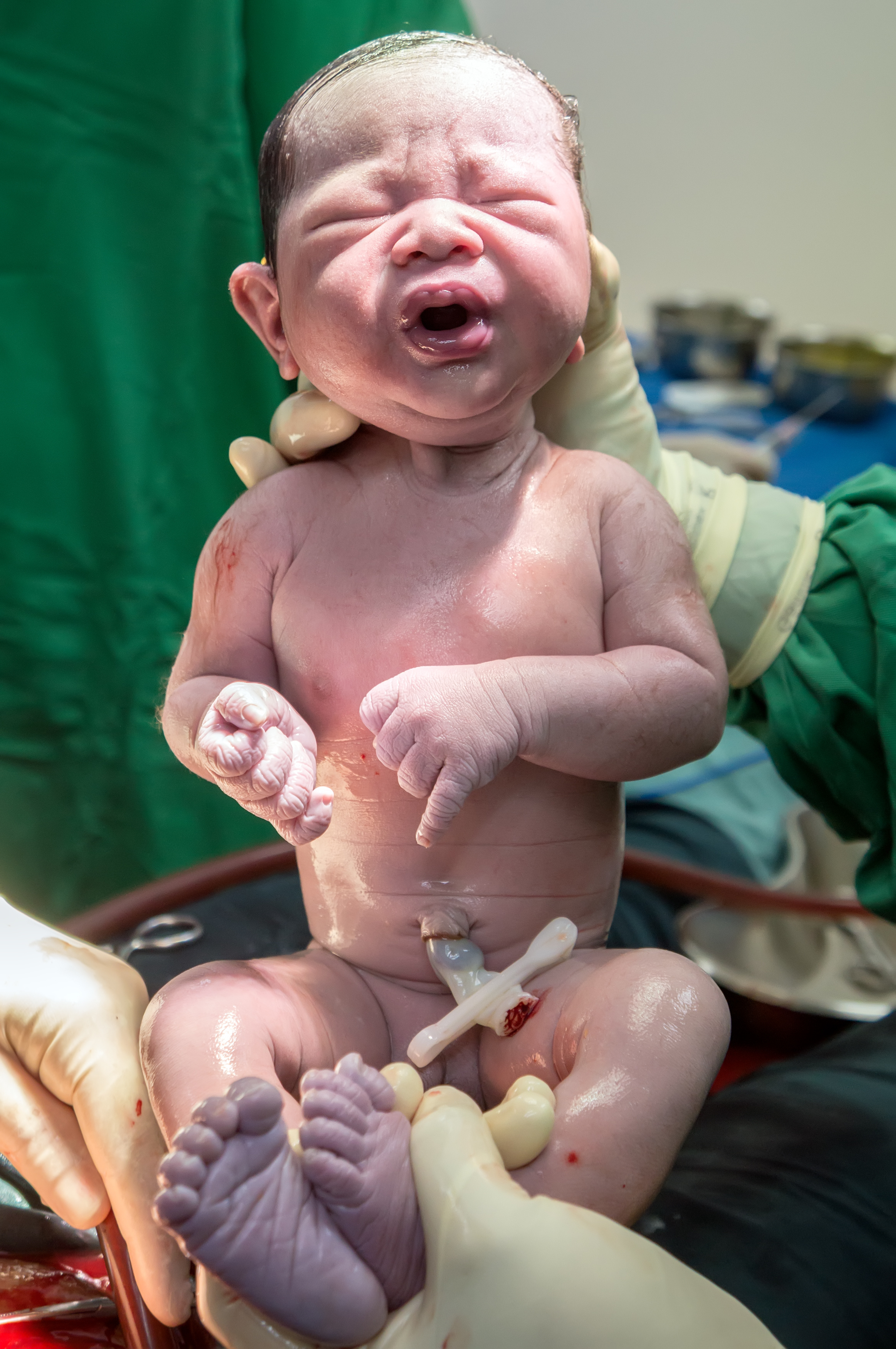 Operation for cesarean section with new born infant in operating